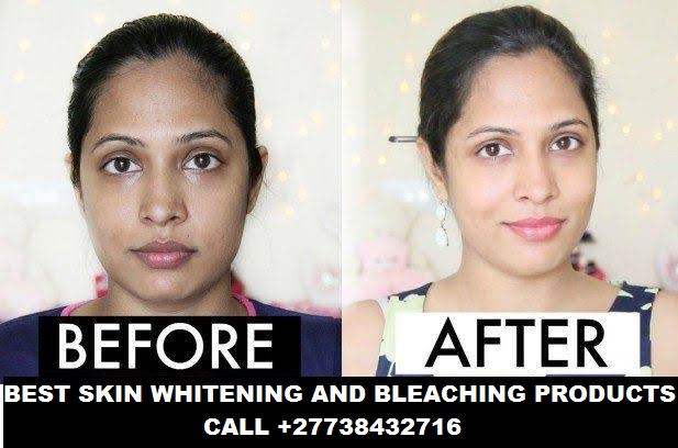 Skin Bleaching and whitening in Togo +27738432716.jpeg